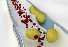 Как быстро почистить сосуды головного мозга народными средствами? Чистка сосудов головного мозга