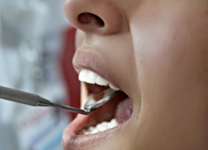 Лечение пародонтоза самыми эффективными народными средствами: лучшие рецепты и способы Пародонтоз