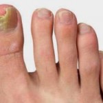 Как быстро вылечить грибок ногтей на ногах народными средствами как лечить грибок ногтей на ногах фото