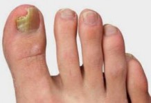 Как быстро вылечить грибок ногтей на ногах народными средствами как лечить грибок ногтей на ногах фото