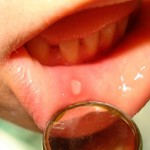Действенное лечение стоматита у взрослых народными средствами Заболевание стоматит