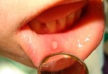 Действенное лечение стоматита у взрослых народными средствами Заболевание стоматит