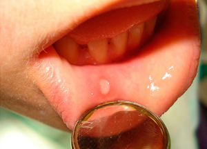 Действенное лечение стоматита у взрослых народными средствами Заболевание стоматит
