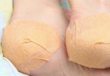 Эффективное лечение шпоры на пятке народными средствами Шпора на пятке