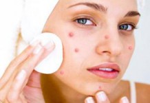 Розовые, белые, черные и гнойные угри на лице: как лечить в домашних условиях лечение розовых угрей на лице