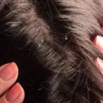 Как избавиться от зуда и перхоти народными средствами в домашних условиях как избавиться от перхоти