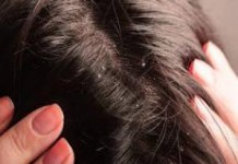 Как избавиться от зуда и перхоти народными средствами в домашних условиях как избавиться от перхоти