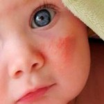 Мелкая красная сыпь на лице и руках у ребенка сыпь на лице у ребенка фото с пояснениями