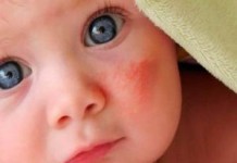 Мелкая красная сыпь на лице и руках у ребенка сыпь на лице у ребенка фото с пояснениями