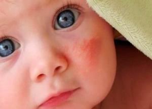Мелкая красная сыпь на лице и руках у ребенка сыпь на лице у ребенка фото с пояснениями