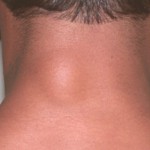 Что такое липома: причины появления и лечение в домашних условиях Липома