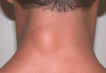 Что такое липома: причины появления и лечение в домашних условиях Липома