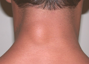 Что такое липома: причины появления и лечение в домашних условиях Липома