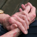 Возможно ли лечение экземы на руках народными средствами? Как избавиться от экземы на руках?