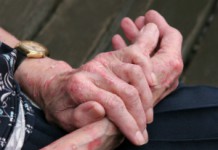 Возможно ли лечение экземы на руках народными средствами? Как избавиться от экземы на руках?