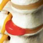 Эффективна ли гимнастика при грыже пояснично-крестцового отдела позвоночника? Упражнения при грыже позвоночника