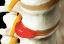 Эффективна ли гимнастика при грыже пояснично-крестцового отдела позвоночника? Упражнения при грыже позвоночника