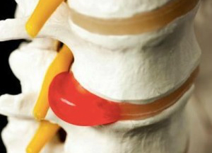 Эффективна ли гимнастика при грыже пояснично-крестцового отдела позвоночника? Упражнения при грыже позвоночника