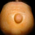 Атерома: лечение доброкачественного образования в домашних условиях Что такое атерома?