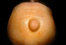 Атерома: лечение доброкачественного образования в домашних условиях Что такое атерома?