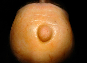 Атерома: лечение доброкачественного образования в домашних условиях Что такое атерома?