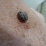 Симптомы и лечение кератомы в домашних условиях Кератома на коже