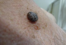 Симптомы и лечение кератомы в домашних условиях Кератома на коже