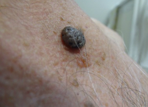 Симптомы и лечение кератомы в домашних условиях Кератома на коже