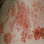 Что такое опоясывающий лишай: симптомы и лечение в домашних условиях Опоясывающий лишай