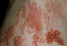 Что такое опоясывающий лишай: симптомы и лечение в домашних условиях Опоясывающий лишай