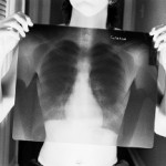 Острый бронхит: каковы симптомы и лечение в домашних условиях? Острый бронхит