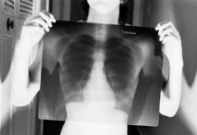 Острый бронхит: каковы симптомы и лечение в домашних условиях? Острый бронхит