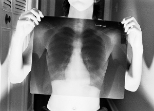 Острый бронхит: каковы симптомы и лечение в домашних условиях? Острый бронхит