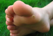 Лечение подошвенной бородавки в домашних условиях: лучшие народные средства Подошвенная бородавка