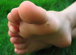 Лечение подошвенной бородавки в домашних условиях: лучшие народные средства Подошвенная бородавка