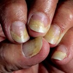 Онихомикоз ногтей: лечение грибкового заболевания в домашних условиях Онихомикоз
