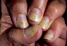 Онихомикоз ногтей: лечение грибкового заболевания в домашних условиях Онихомикоз