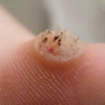 Почему появляются бородавки на руках: лечение в домашних условиях Бородавки на пальцах рук