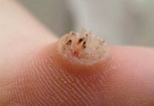 Почему появляются бородавки на руках: лечение в домашних условиях Бородавки на пальцах рук