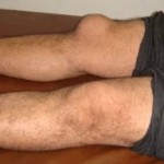 Причины развития бурсита коленного сустава и лечение в домашних условиях Бурсит коленного сустава