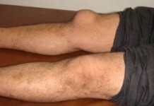 Причины развития бурсита коленного сустава и лечение в домашних условиях Бурсит коленного сустава