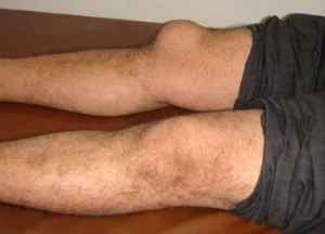 Причины развития бурсита коленного сустава и лечение в домашних условиях Бурсит коленного сустава