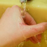 Способы лечения волдырей после ожогов в домашних условиях Холодная вода при ожоге