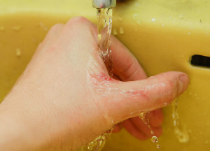 Способы лечения волдырей после ожогов в домашних условиях Холодная вода при ожоге