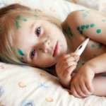 Симптомы ветрянки у детей и схема лечения в домашних условиях Ветрянка у детей