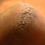 Причины появления трещин на пятках и их лечение в домашних условиях Трещины на пятках