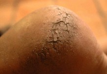 Причины появления трещин на пятках и их лечение в домашних условиях Трещины на пятках