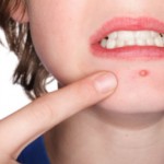 Эффективное лечение фурункулеза в домашних условиях Фурункулез