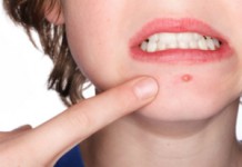 Эффективное лечение фурункулеза в домашних условиях Фурункулез