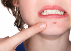 Эффективное лечение фурункулеза в домашних условиях Фурункулез